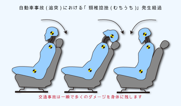 自動車事故（追突）における「頸椎捻挫（むちうち）」発生経過図